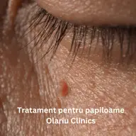 Cum se pot indepărta papiloamele