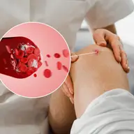 Infiltrațiile PRP în genunchi: o șansă de recuperare pentru tine?