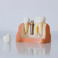 Cât de durabile sunt implanturile dentare? Așteptări vs realitate