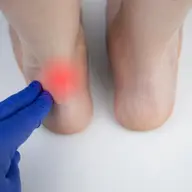 Ruptura de tendon ahilean: opțiuni de tratament și recuperare pas cu pas