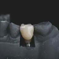 Top 5 beneficii ale implantului dentar