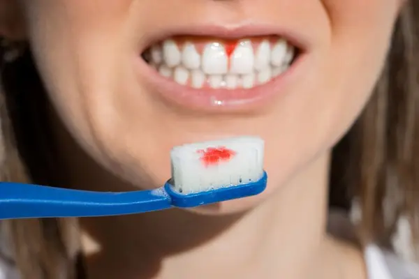 Lupta împotriva bolilor gingivale: prevenție și tratament
