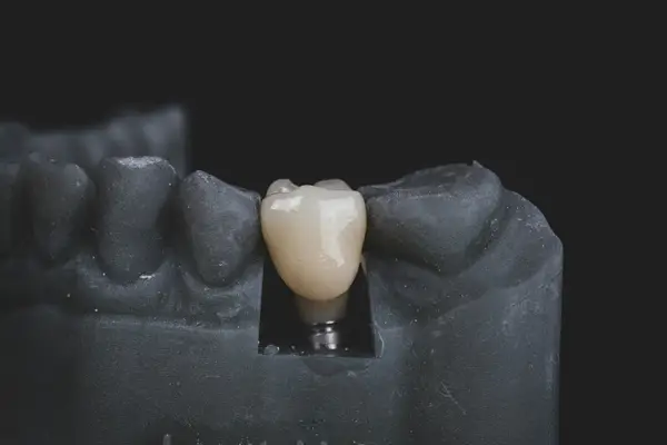 Top 5 beneficii ale implantului dentar