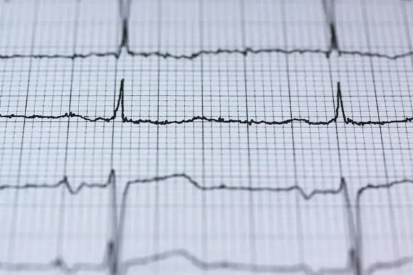 EKG, ecocardiografie sau Holter, de ce investigație cardiologică ai nevoie și când?