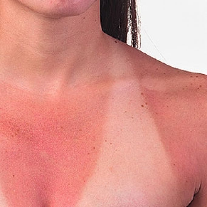 Cum sa tratezi pielea arsa de soare