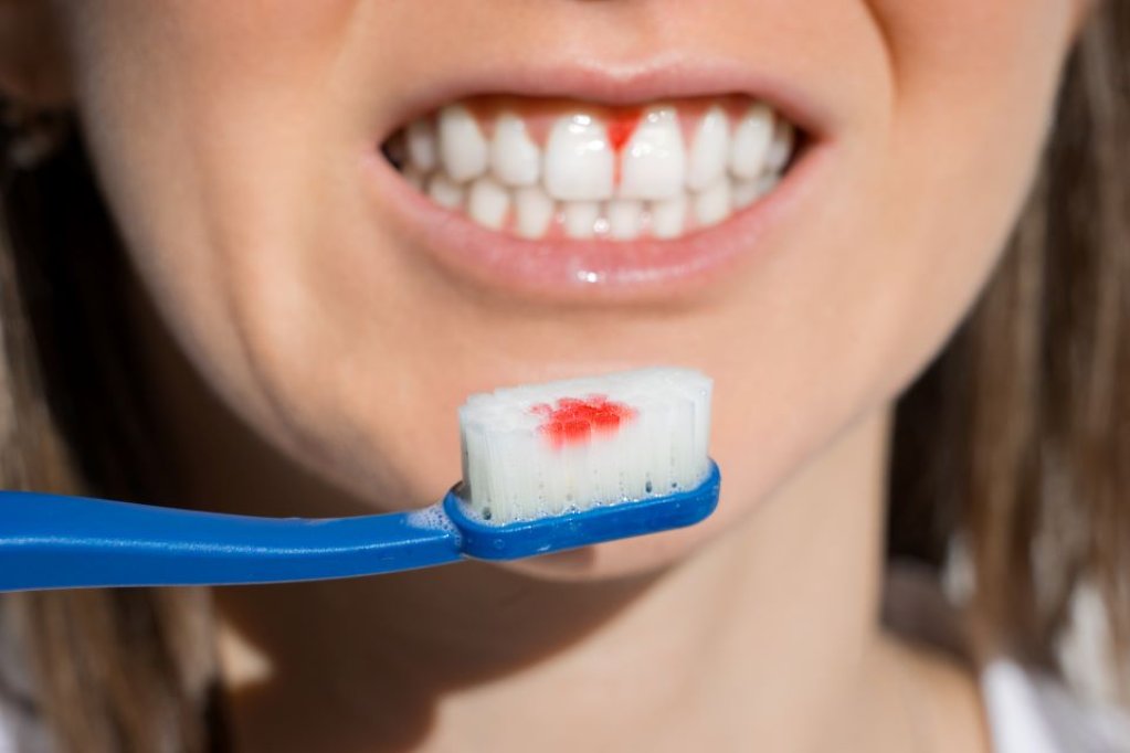 Lupta împotriva bolilor gingivale: prevenție și tratament
