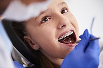 Beneficiile pe termen lung ale purtării unui aparat dentar
