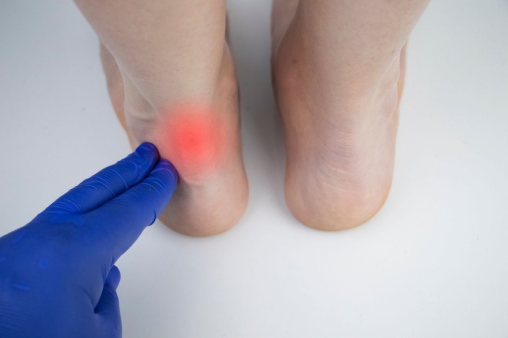 Ruptura de tendon ahilean: opțiuni de tratament și recuperare pas cu pas