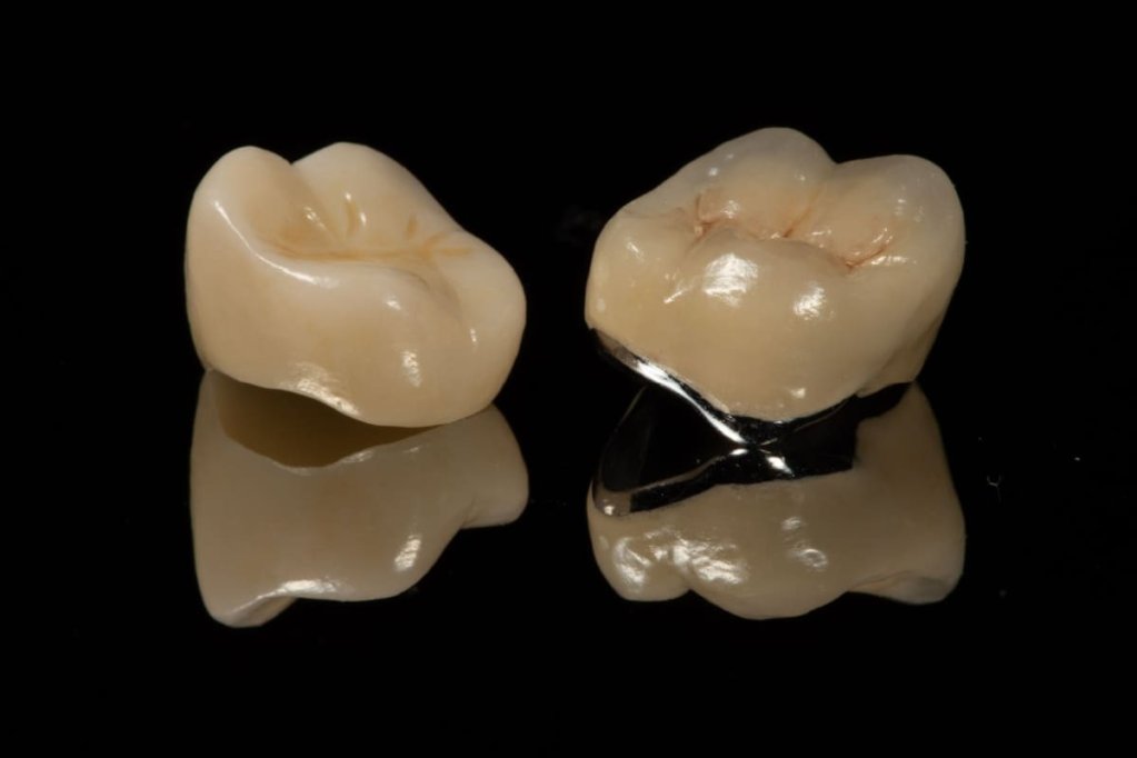 Îngrijirea corectă a coroanelor dentare din zirconiu: 3 sfaturi utile