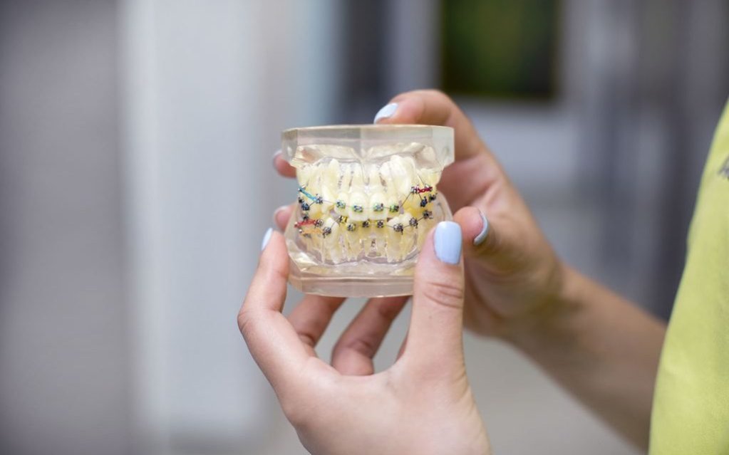 Reguli de îngrijire orală pe durata tratamentului cu aparat dentar