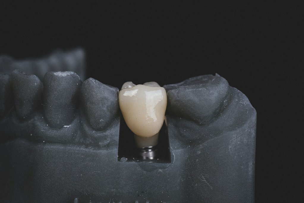 Top 5 beneficii ale implantului dentar