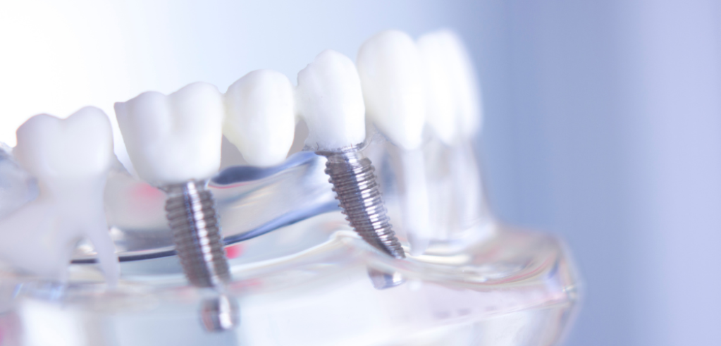 Care este diferența dintre implantul dentar Bredent și STRAUMANN?