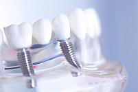 Care este diferența dintre implantul dentar Bredent și STRAUMANN?