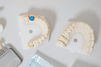 Ghid complet despre implanturile dentare moderne recomandat de Dr. Durbac